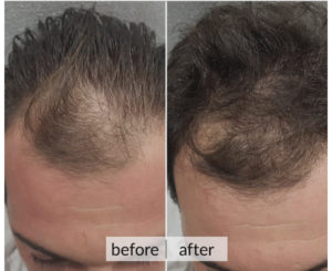 Prima e dopo capelli — risultato 6