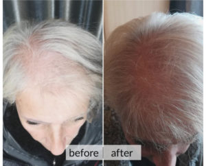 Prima e dopo capelli — risultato 11