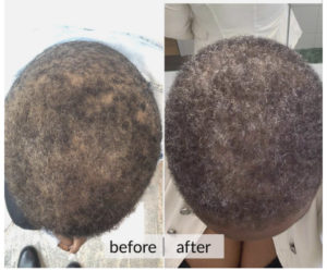 Prima e dopo capelli — risultato 12