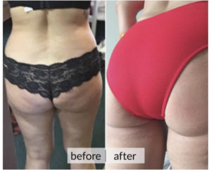 Prima e dopo cellulite e ritenzione idrica — risultato 1