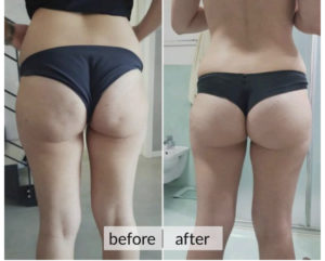 Prima e dopo cellulite e ritenzione idrica — risultato 2