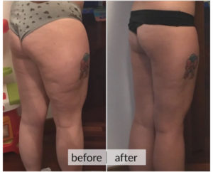 Prima e dopo cellulite e ritenzione idrica — risultato 3