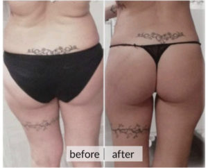 Prima e dopo cellulite e ritenzione idrica — risultato 4