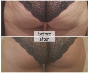 Prima e dopo cellulite e ritenzione idrica — risultato 5