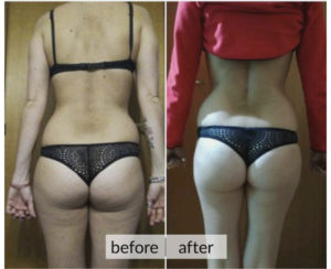 Prima e dopo cellulite e ritenzione idrica — risultato 6