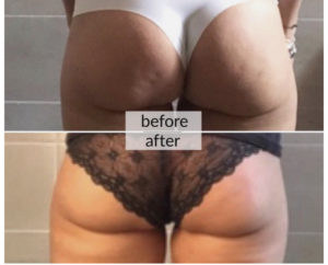 Prima e dopo cellulite e ritenzione idrica — risultato 12