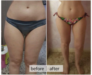 Prima e dopo cellulite e ritenzione idrica — risultato 11