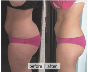 Prima e dopo cellulite e ritenzione idrica — risultato 9