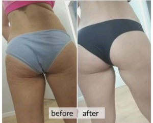 Prima e dopo cellulite e ritenzione idrica — risultato 10