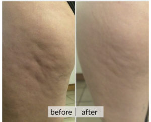 Prima e dopo cellulite e ritenzione idrica — risultato 8