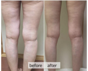 Prima e dopo cellulite e ritenzione idrica — risultato 7