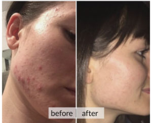 Prima e dopo acne e macchie della pelle — risultato 1