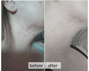 Prima e dopo acne e macchie della pelle — risultato 2
