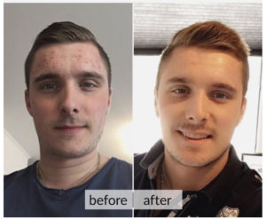 Prima e dopo acne e macchie della pelle — risultato 3