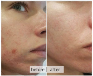 Prima e dopo acne e macchie della pelle — risultato 4