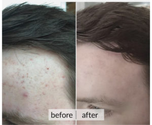 Prima e dopo acne e macchie della pelle — risultato 5