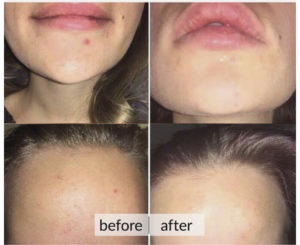 Prima e dopo acne e macchie della pelle — risultato 6
