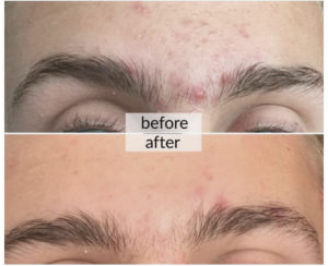 Prima e dopo acne e macchie della pelle — risultato 7