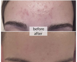 Prima e dopo acne e macchie della pelle — risultato 8