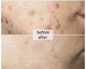 Prima e dopo acne e macchie della pelle — risultato 9