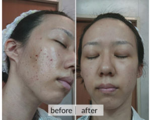Prima e dopo acne e macchie della pelle — risultato 10
