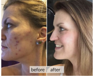 Prima e dopo acne e macchie della pelle — risultato 11