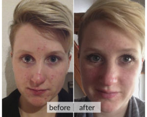 Prima e dopo acne e macchie della pelle — risultato 12