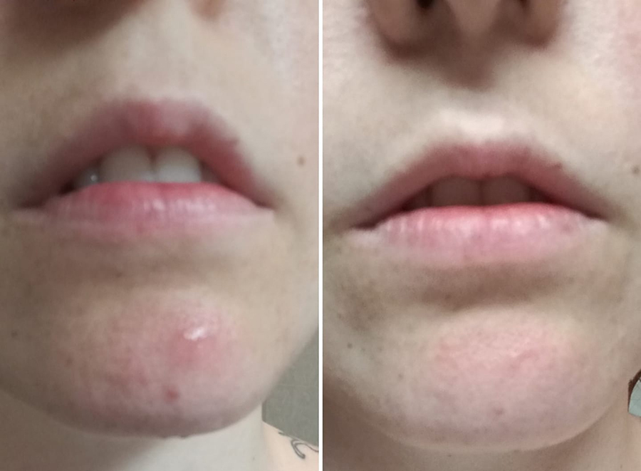 Risultato prima e dopo di Chiara